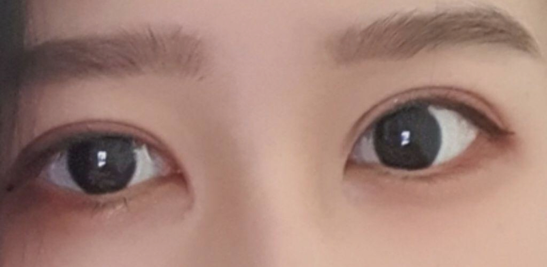 [Нүд] Мөринг - Урд зүсэлт, Нүдний дахин мэс засал