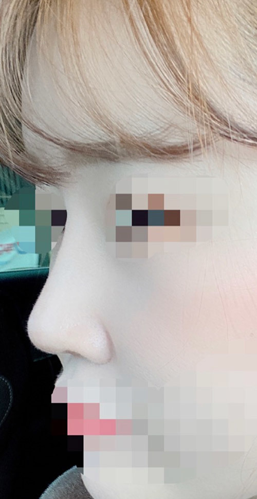 [Хамрын мэс засал] Шаб - Хамар