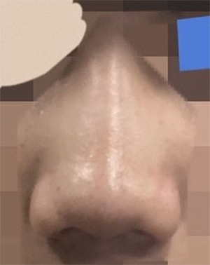 [Хамрын] Гана мэс засал - Хамар