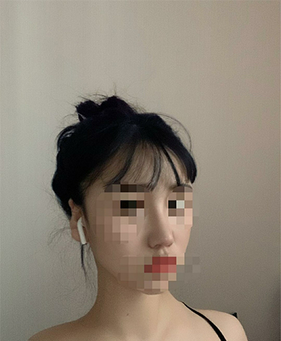 [Хамрын мэс засал] happy1222 - Хамар