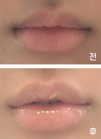 [Бяцхан] ㅎРингㅇ - Уруулын булан, уруулын филлер