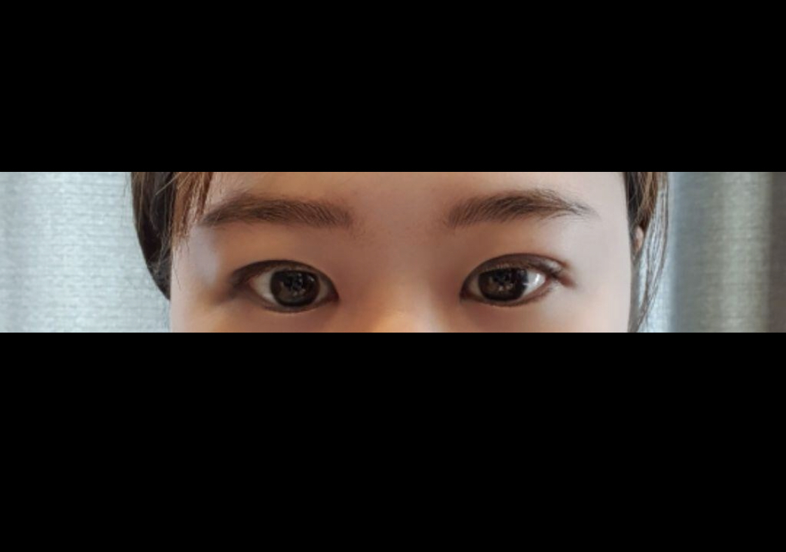 [Нүд] Цзирулин - Доод зовхины тайралт, Арьсны тайралт