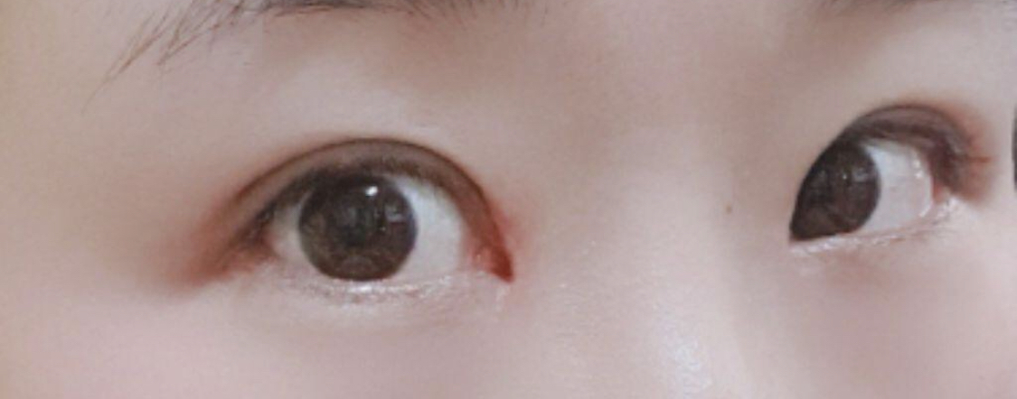 [Нүд] Пингүүжин - Нүдний хэлбэр засах, зүсэлт