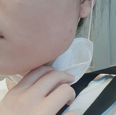 [Бяцхан] Сөүл - эрүүний ботокс