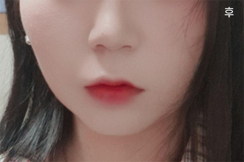 [Анти-Эйжинг] alss12 - Нүүрний өөх соруулах