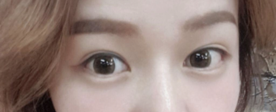 [Нүд] Хүссэнээрээ хийлгэ - Арьс сунгалт, Доод зовхины сунгалт