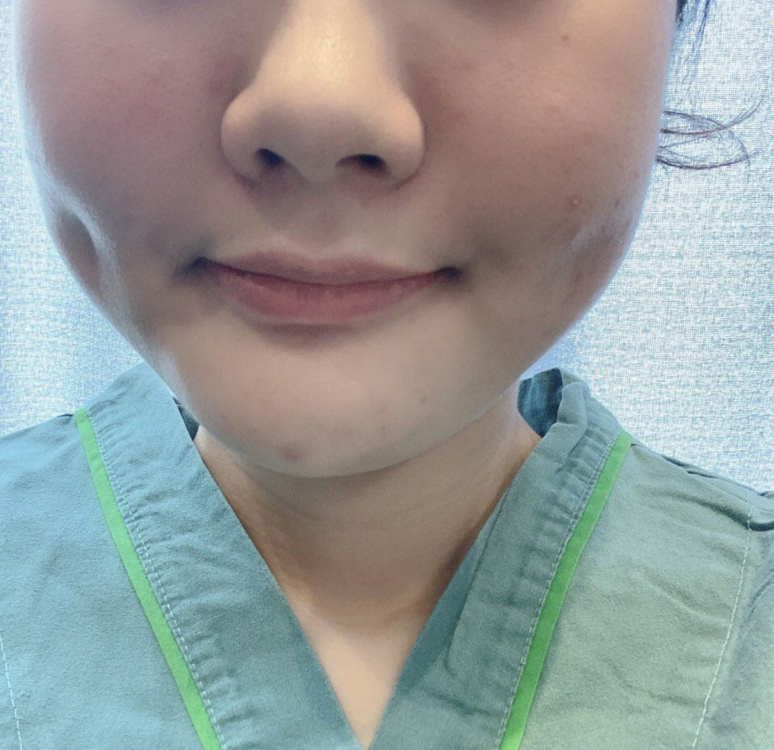 [Өөх соруулах] kimy226 - Нүүрний өөх соруулах