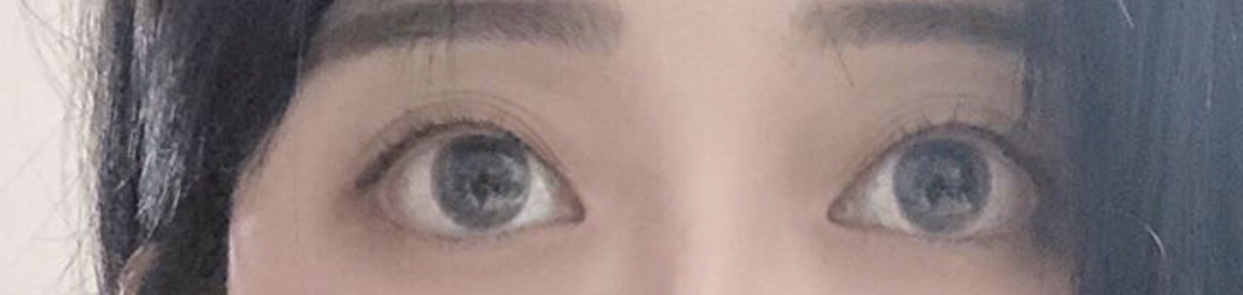 [Нүд] Hitwo - Нүдний хэлбэр засах, Булцуу оёх