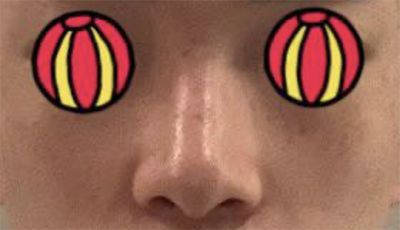 [Хамрын мэс засал] Хёни9801 - Хамар