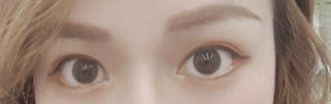 [Нүд] Хүссэнээрээ хийлгэ - Арьс тайрах, доод зовхины унжуулалт