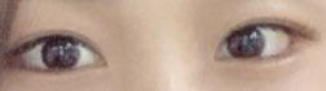 [Нүд] Сэргэг өглөө - Доод зовхины тайралт, хажуугийн тайралт