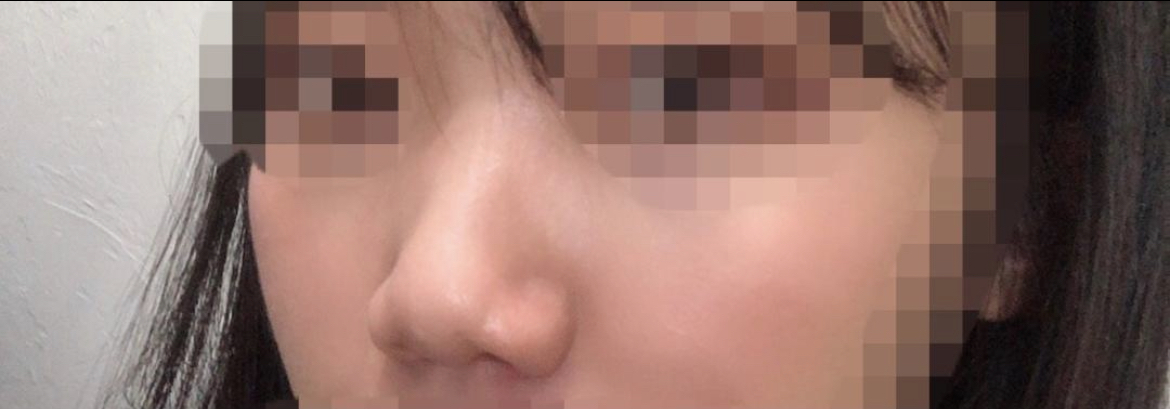 [Хамрын мэс засал] Яагаад утсаа авахгүй байгаа юм бэ? - Хамар