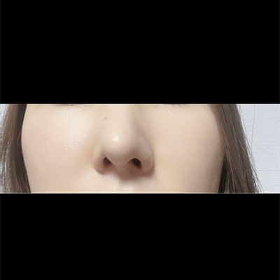 [Хамрын мэс засал] 232323 - Хамар