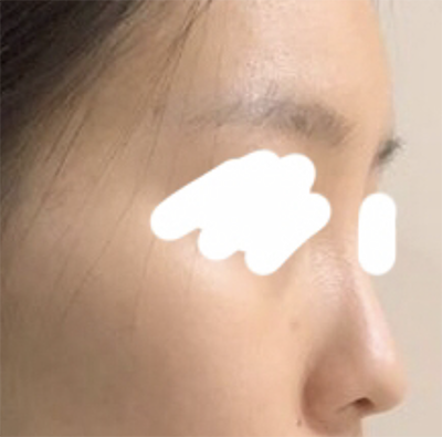 [Хамрын мэс засал] Луужин бөмбөг - Хамар