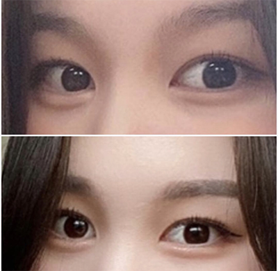 [Нүд] Ёндуду - Давхраа, Зүслэг