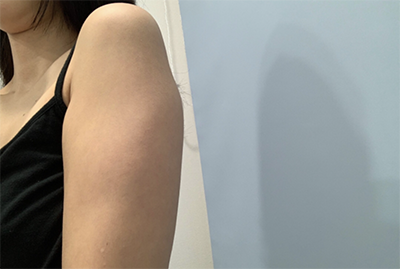 [Өөх соруулах] Гайхалтай үр дүн - Гар, суганы өөх соруулах