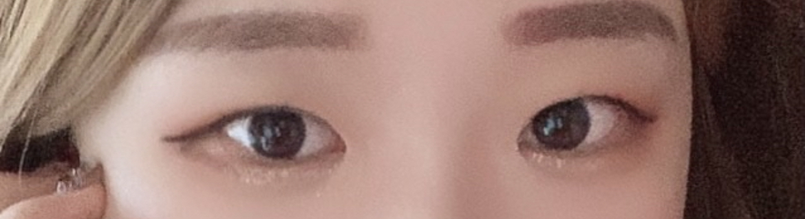 [Нүд] Рюллюү - Нүдний Давтан Хагалгаа