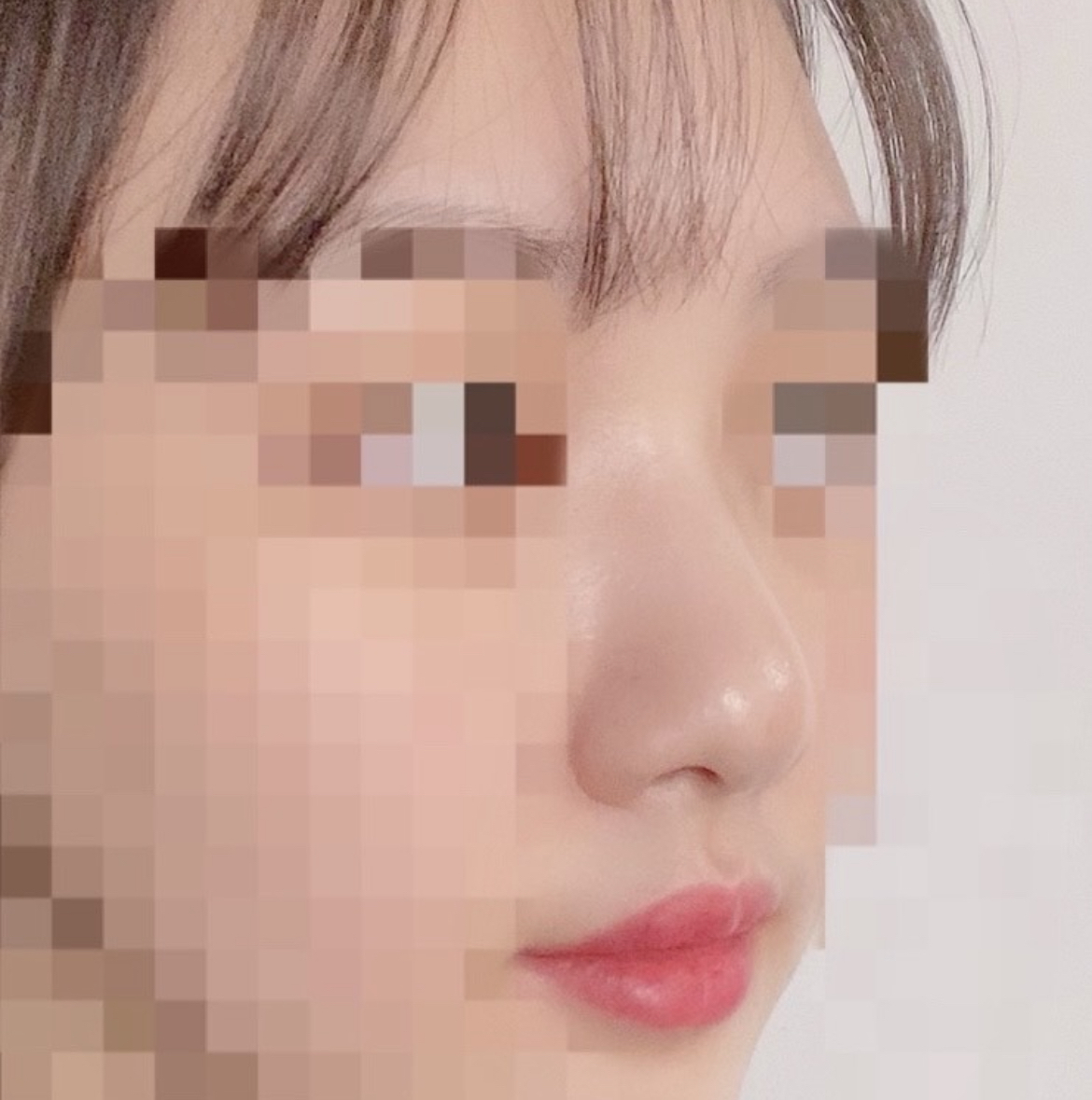 [Хамрын] Лонгдаранса - Хамрын гоо сайхны мэс засал