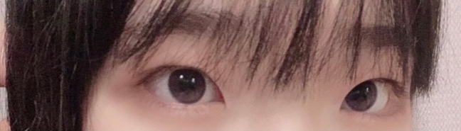 [Нүд] Куромиs2 - Давхар зовхины мэс засал (оёдолтой), Урд зовхины өргөтгөл