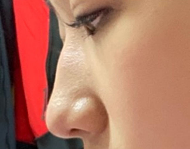 [Хамрын мэс засал] Бумбагар хамар - Хамар (силикон)