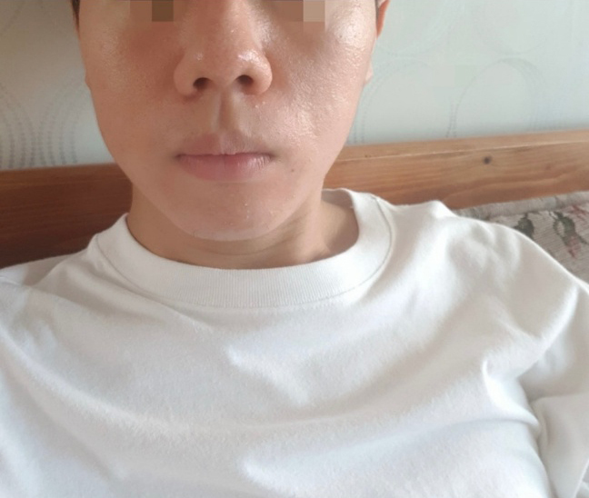 [Хамрын мэс засал] Хамрын далавчийг жийрэгжүүлэх - Хамар