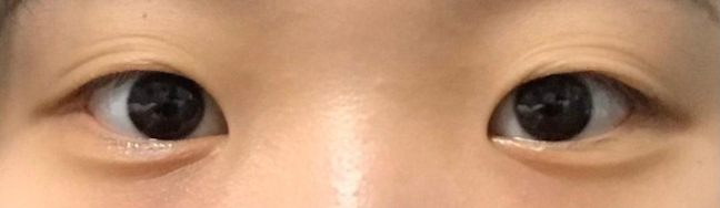 [Нүд] Гүзээлзгэнэ өгөөч - Урд зүсэлт, нүдний хэлбэр засах