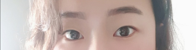 [Нүд] Равиравион - Давхар зовхи (мэс заслын арга)