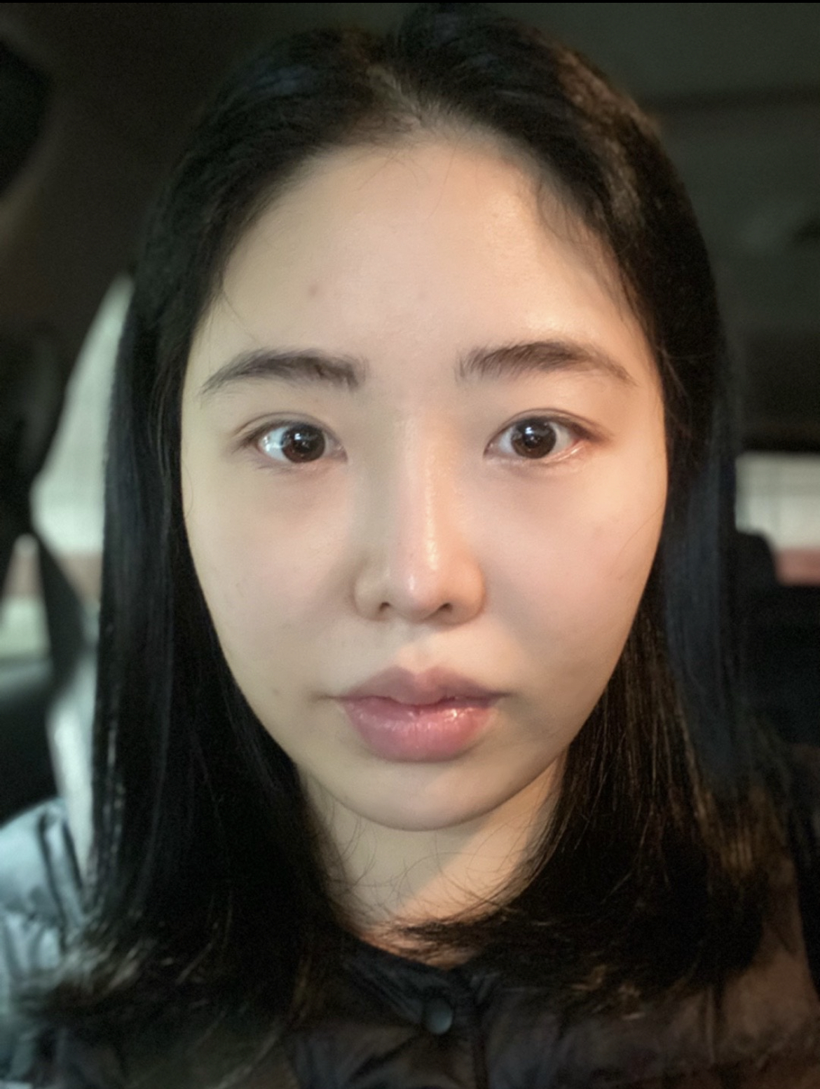 [Нүүрний хэлбэр засах мэс засал] Маршалл спикер - Нүүрний хэлбэр засах 3 төрлийн мэс засал