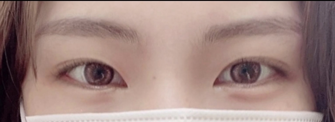 [Нүд] itxufx - Дээд зовхи засвар, Доод зовхи засвар