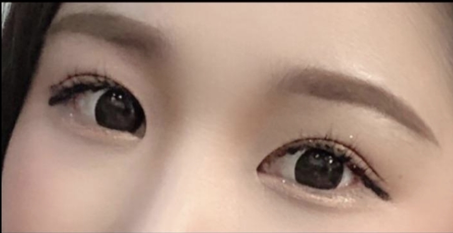 [Нүд] sidhd22 - Арын болон доод зовхины тайралт