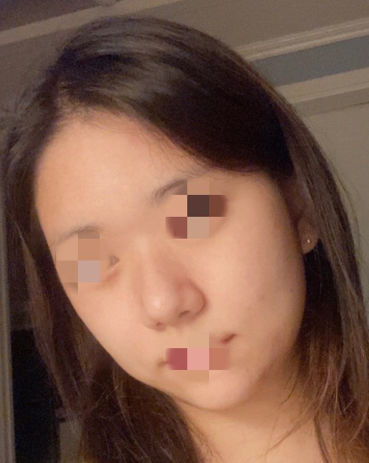 [Нүүрний контур] Айшер - Контур, хамар, нүүрний өөх соруулах