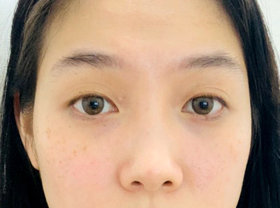 [Нүд] Бетгэл - Нүд, Хамар