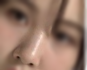 [Хамрын] Хамрын мэс засал - Хамар