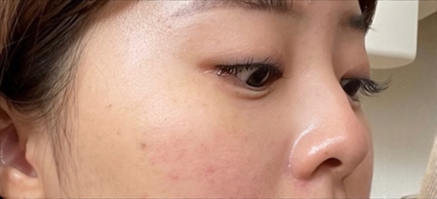 [Хамрын] Мянгмянг - Хамар