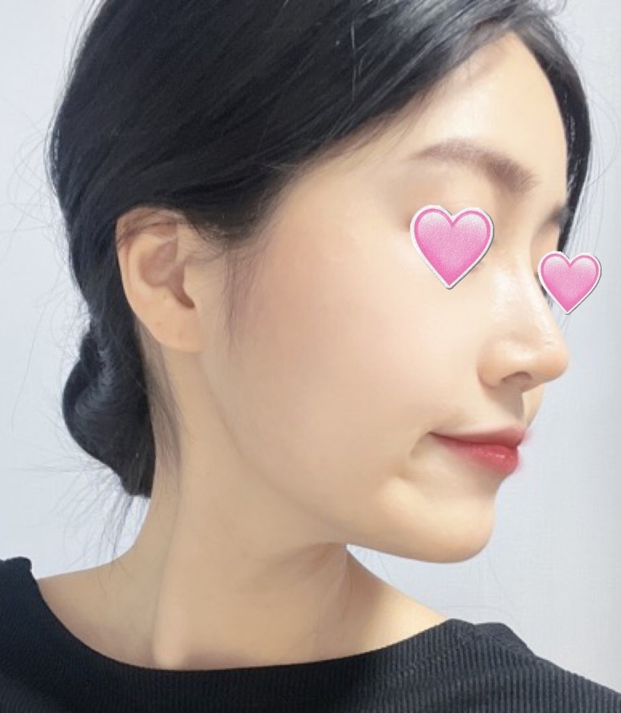 [Хамрын мэс ажилбар] Беби Фокс - Хамар