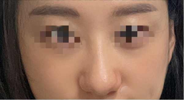 [Хамрын мэс засал] Райни - Хамар