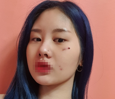 [Нүд] Эцэг шиг хамгийн шилдэг - Нүд, нүүрний өөх соруулах