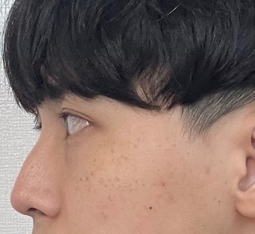 [Хамрын мэс засал] Hip Hinge - Хамар