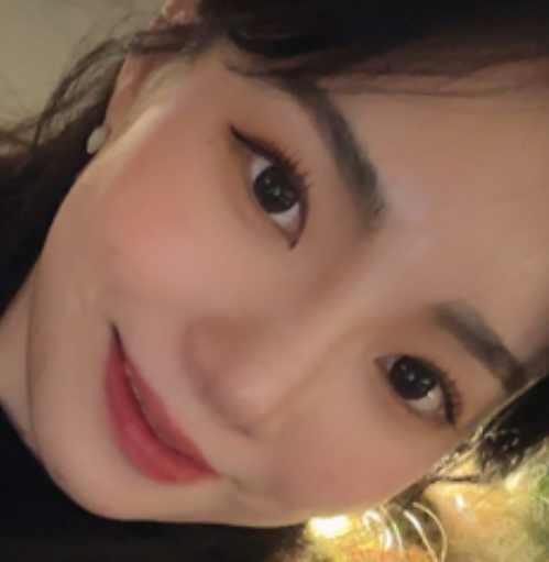 [Хамрын мэс ажилбар] Мөнгөл үүл - Хамар, өөх шилжүүлэн суулгах