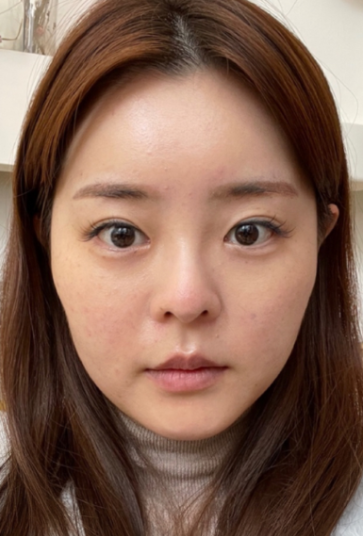 [Хамрын] МингАмингО - Нүд, Хамар, Нүүрний Өөх Соруулах