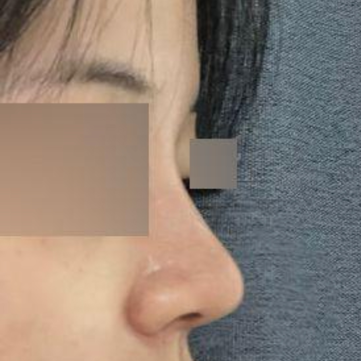 Виверс гоо сайхны мэс заслын хамрын мэс засал хийлгэснээс хойш 1 сарын дараах байдал