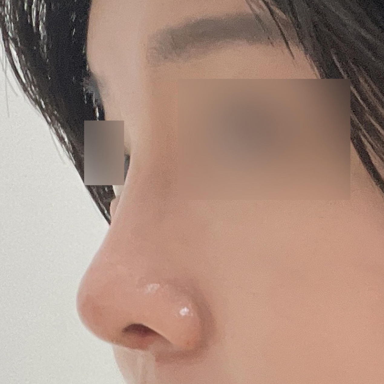 Би хамар томсгох мэс засал хийлгэсэн~! 