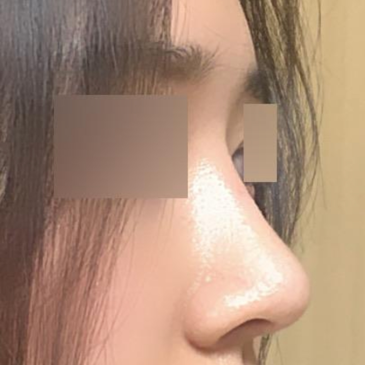 Тэгш бус, төмрөг хамар засварлуулсан