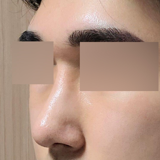 Хамрын мэс заслын дараах нэг сарын тойм