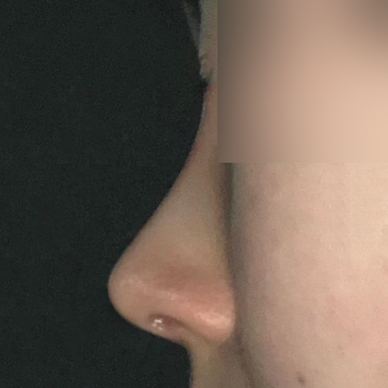 Би Вэверс гоо сайхны мэс заслын эмнэлгийн дарга Со Сын Жо-д хамраа мэс засалд оруулснаас хойш 1 сар болж байна!