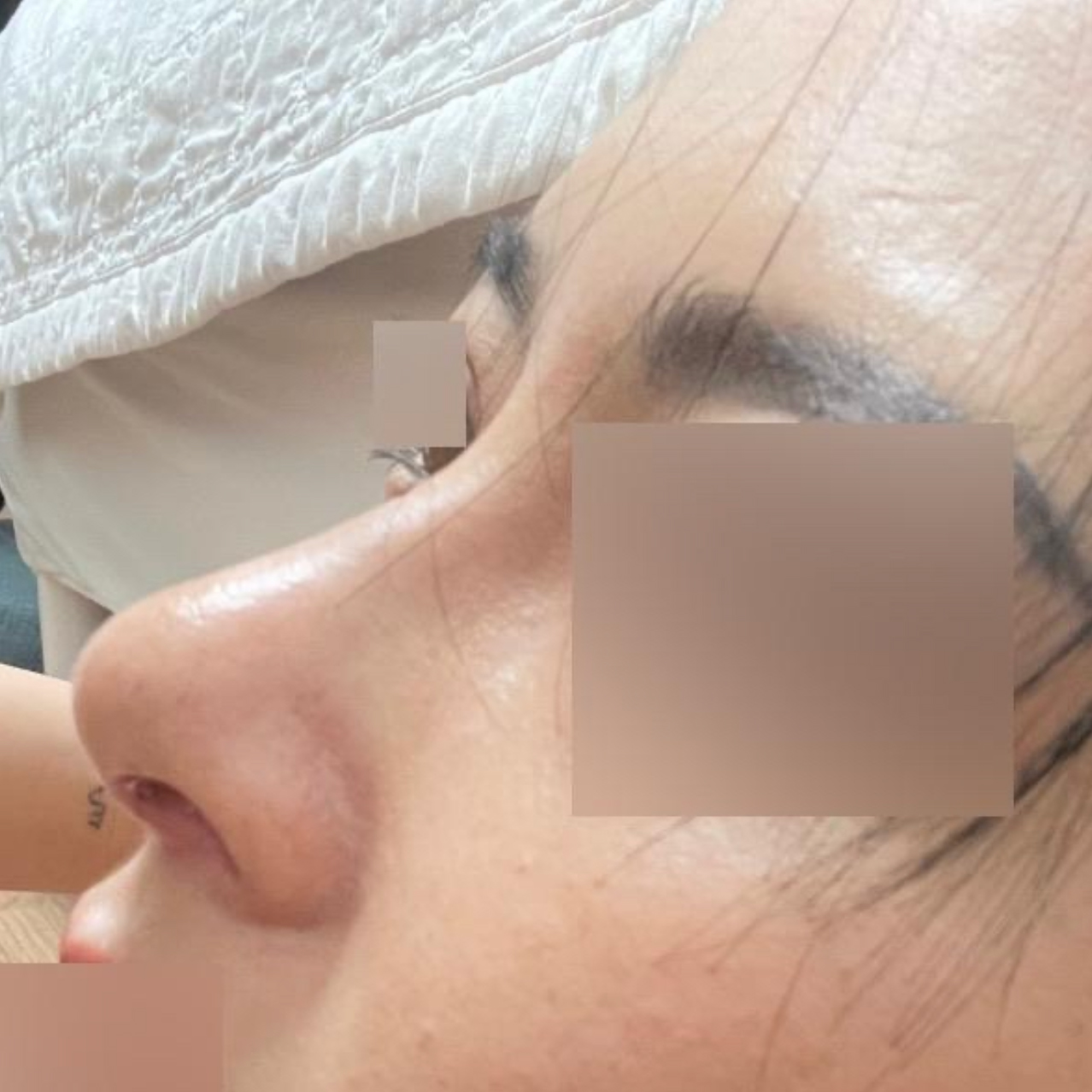 Би протезгүй хамар заслын мэс засал хийлгэсэн ^^