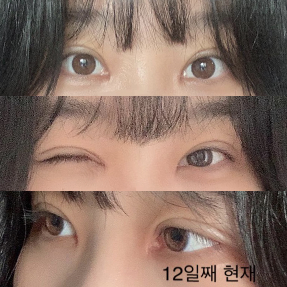 Нүдний давхар мэс заслын үр дүнд үнэхээр сэтгэл хангалуун байгаа тухай жинхэнэ сэтгэгдэл