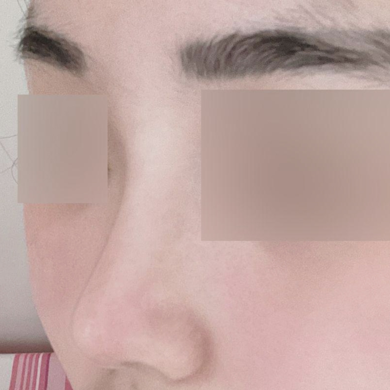 Хамрын богино + үйл ажиллагааны хамар засварын мэс засал хийлгээд 3 сар болж байна!