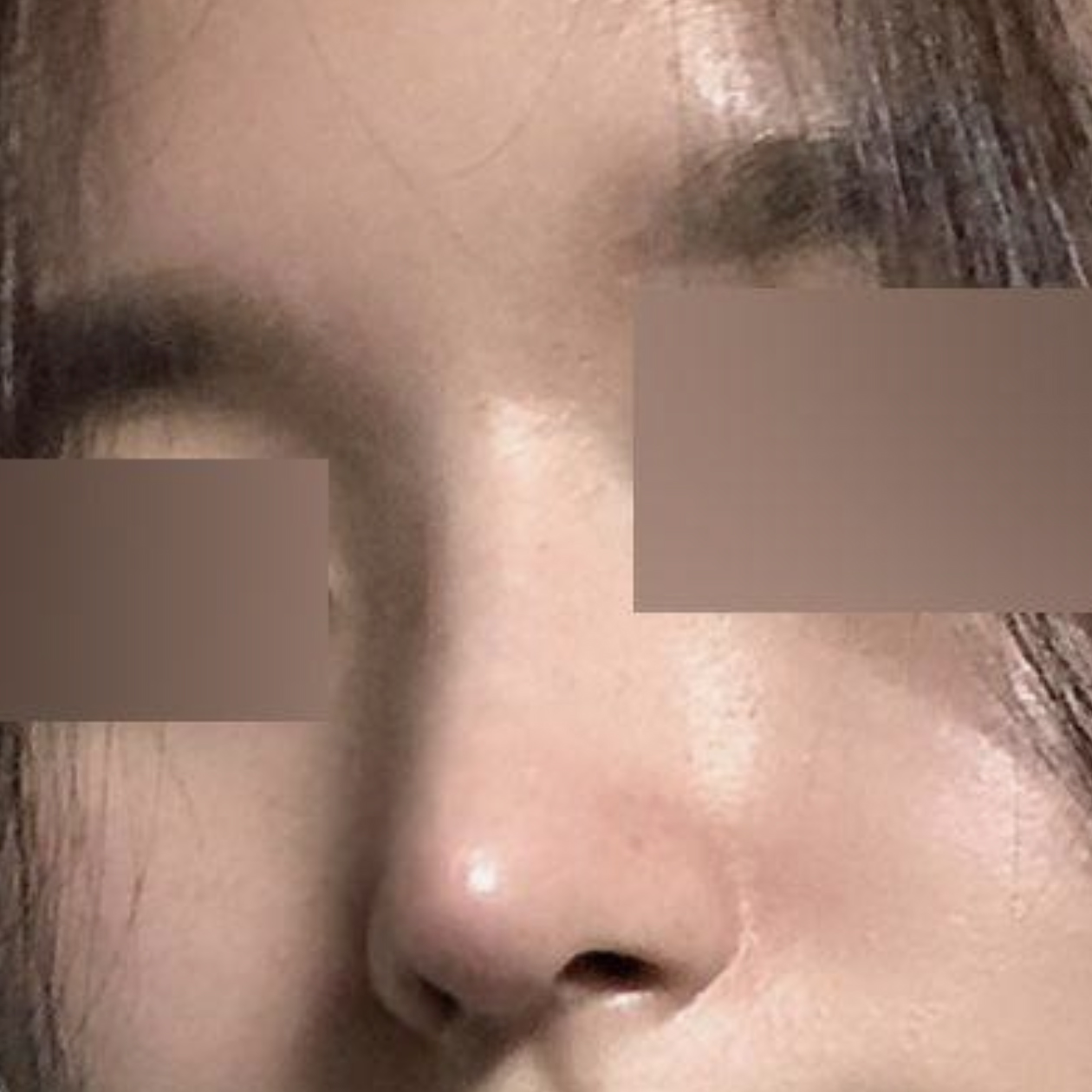 Шулуун шугамаар мэс засал хийлгэснээс хойш 2 сар боллоо