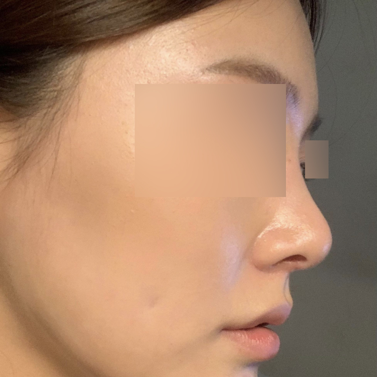 Хайкогоос харьцуулшгүй хамарны мэс засал хийлгэсний дараах хоёр сарын тойм